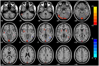 Study of Brain Structure and Function in Chronic Mountain Sickness Based on fMRI